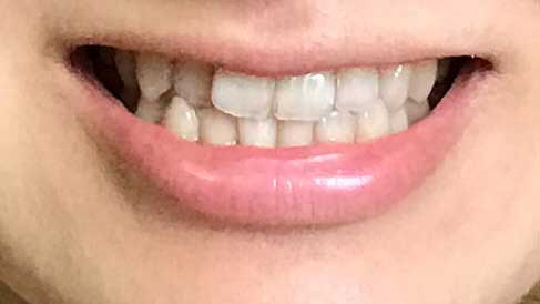 治療前の歯並び